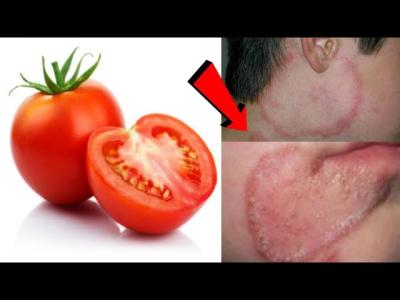 दद खज खजल  दनय क 3 दन म छटट कर दग  Fungal infections treatment