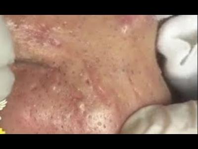 Pele com muita Acne  Limpeza de Pele Profunda  Clínica  Centro estética