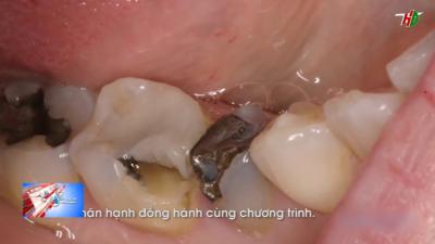 Phương pháp inlay  onlay trong điều trị sâu răng